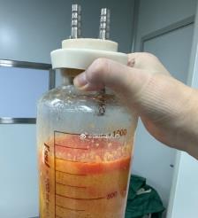 双鸭山水动力吸脂手术要做多久？